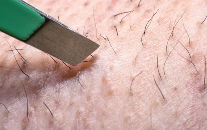 Ingrown Hair Penyebab dan Rekomendasi Produk untuk Mengatasinya