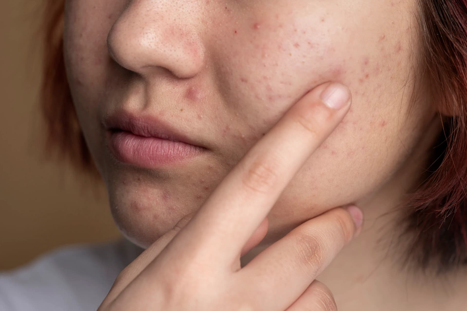 5 Ingredient Aktif Terbaik untuk Wajah Berjerawat dari Dreamlab