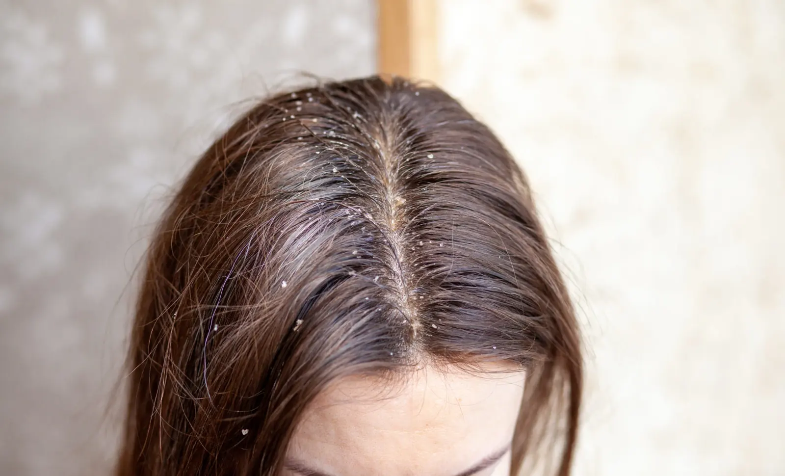 Rambut Bebas Ketombe, Gatal, dan Flaky dalam Waktu Singkat.