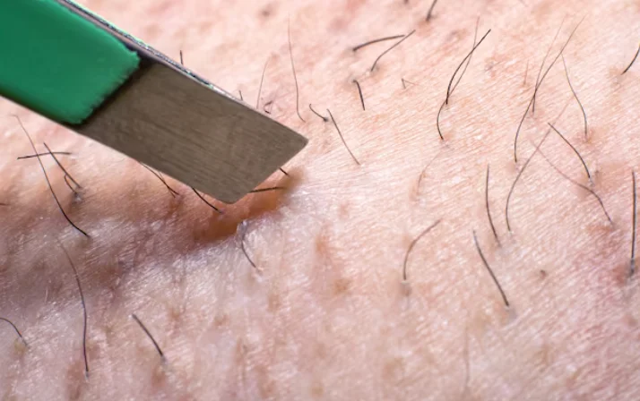Ingrown Hair Penyebab dan Rekomendasi Produk untuk Mengatasinya